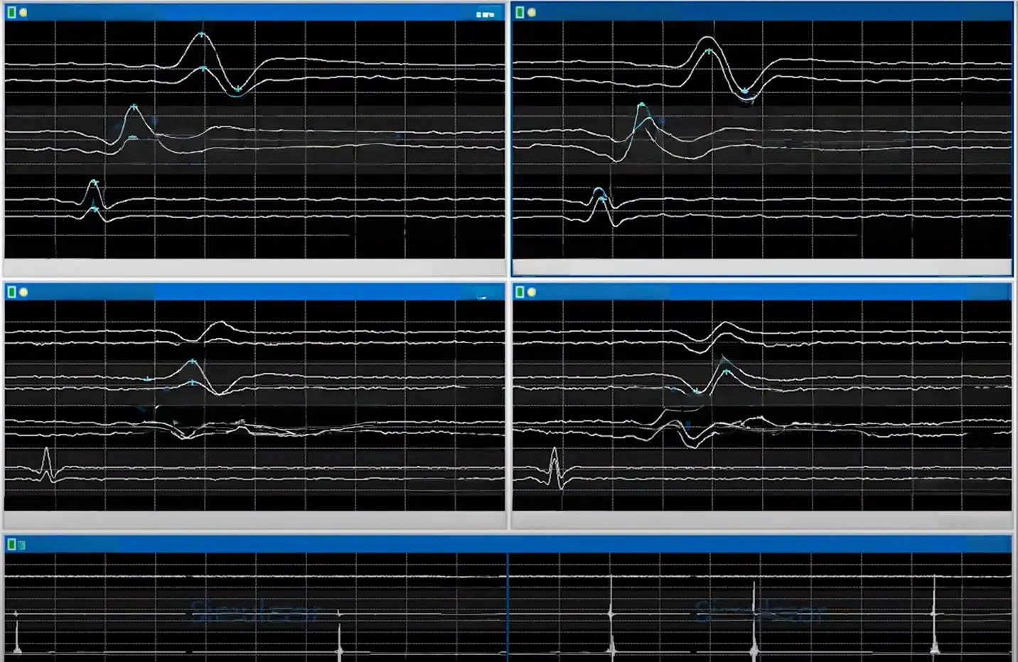Ultrasonik Aspiratör Cihazı